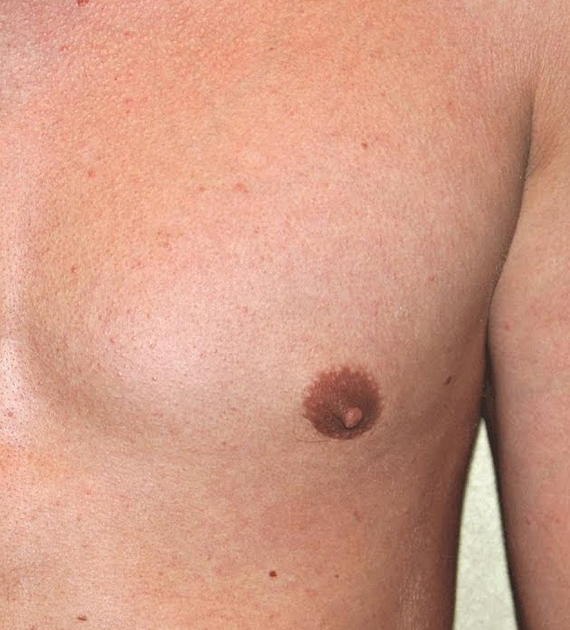 Gynecomastia Consultation Image